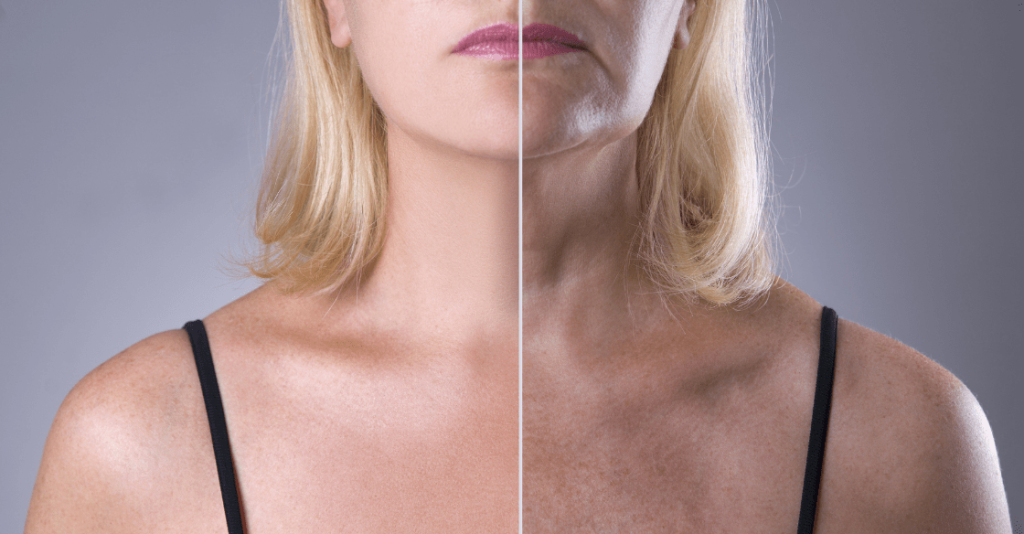 How To Treat Neck Wrinkles and Sagging SD Botox
