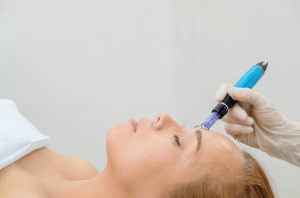 Morpheus8 vs Vivace: Which RF Microneedling is Better?