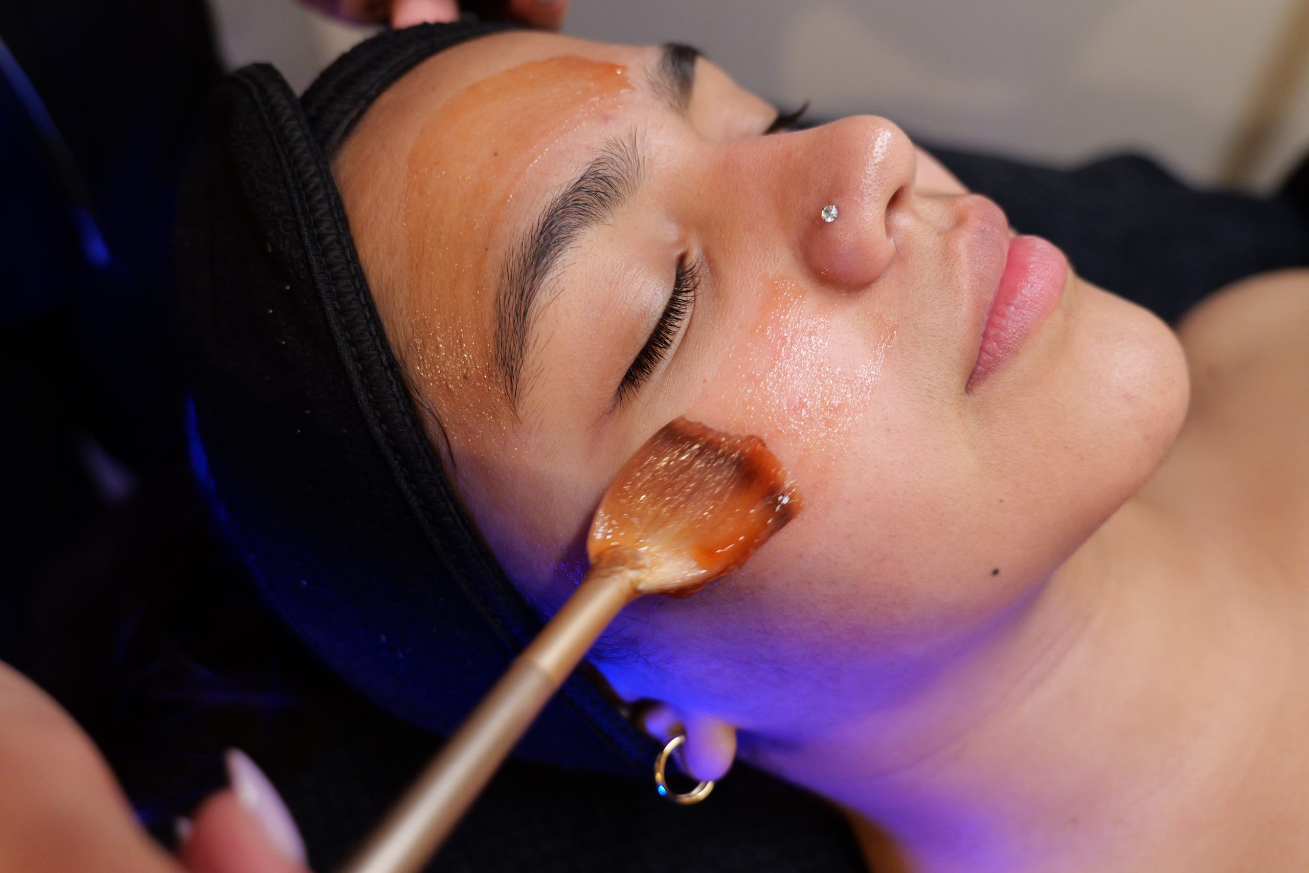 Chemical peel