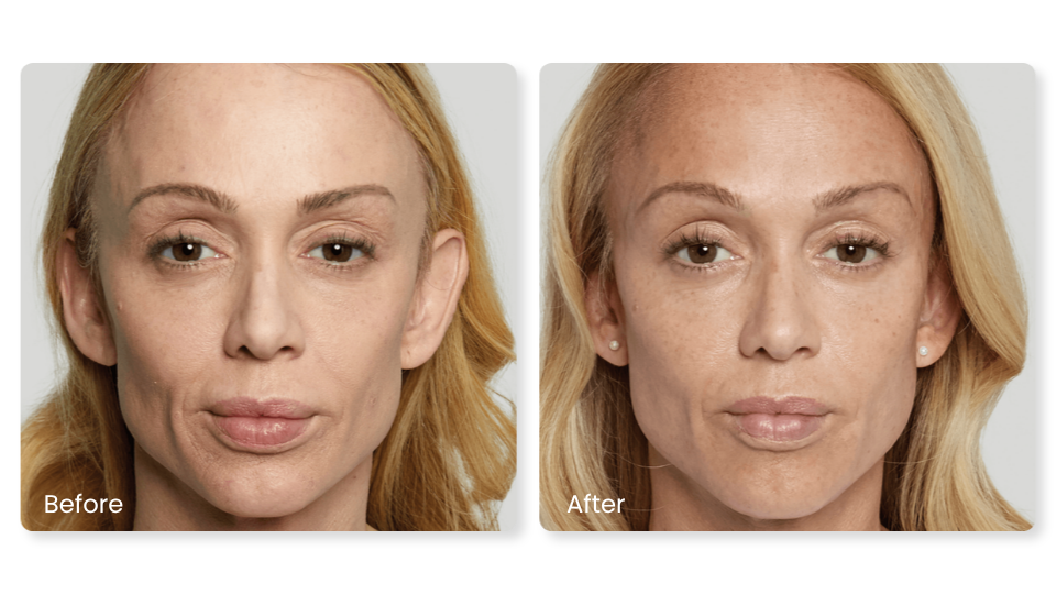 Sculptra in San Diego