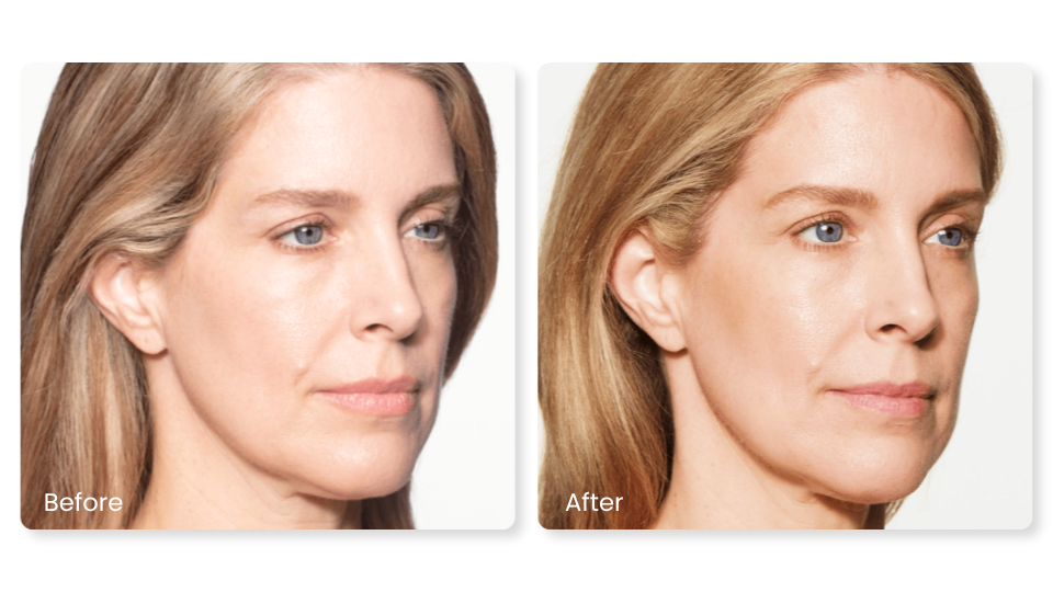Sculptra before and after