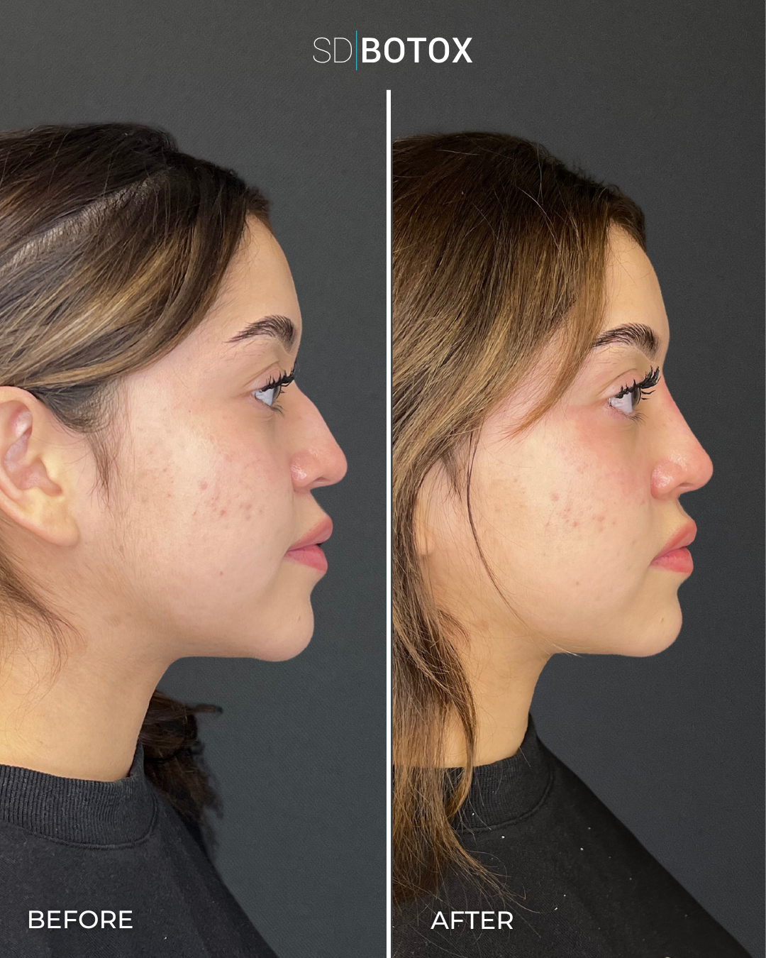 Liquid rhinoplasty before and after at SDBotox San Diego