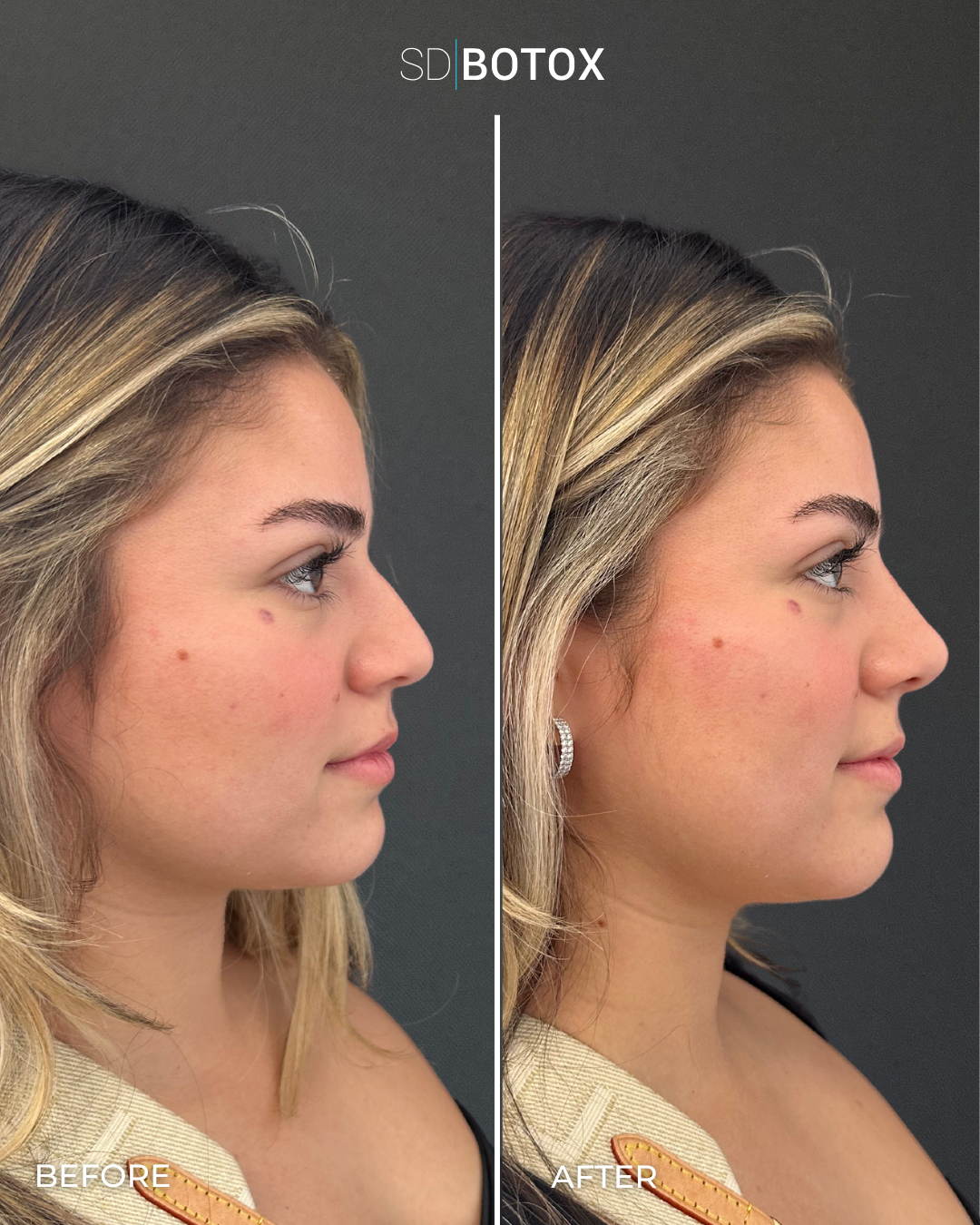 Liquid rhinoplasty before and after at SDBotox San Diego