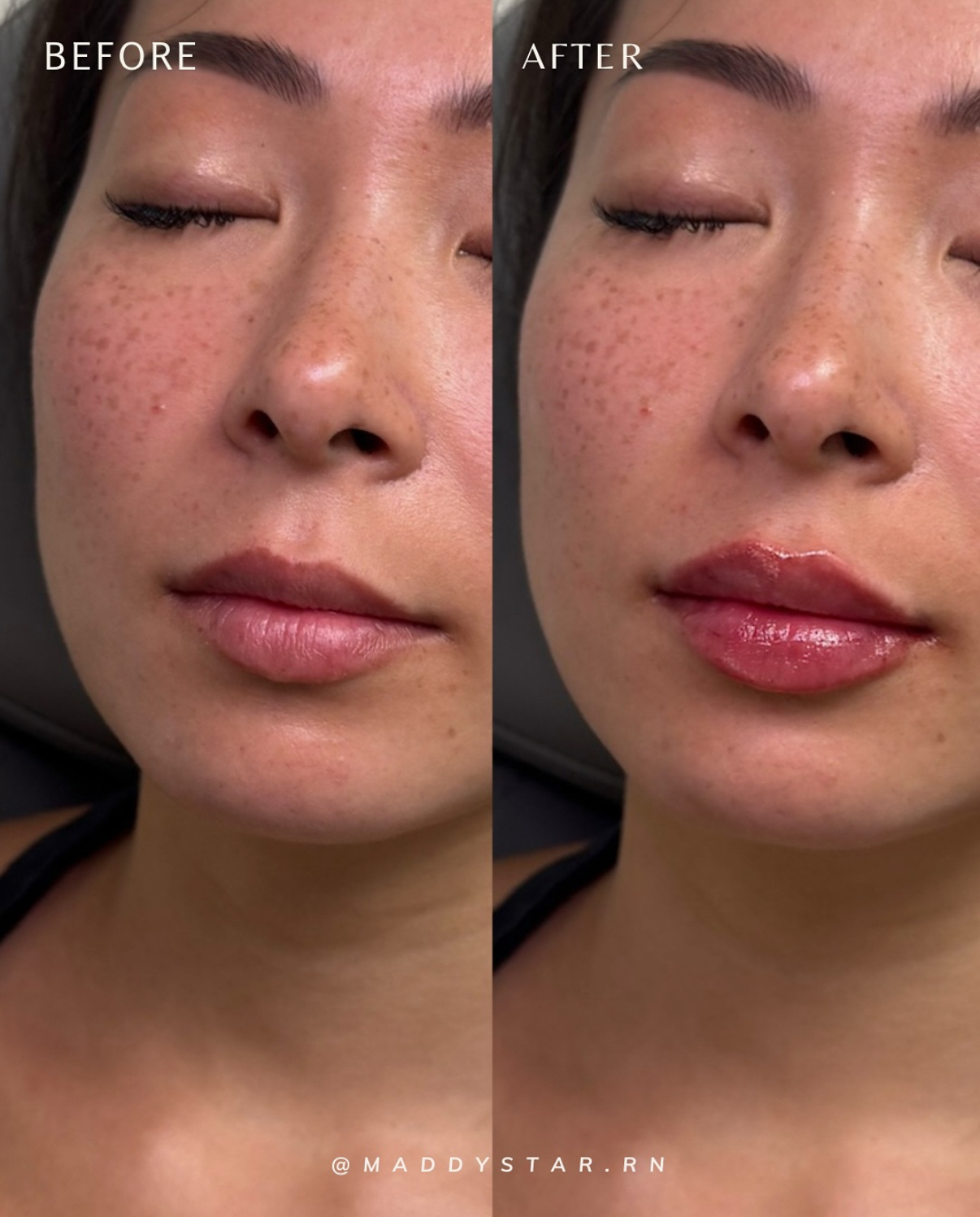 Lip filler before and after at SDBotox San Diego