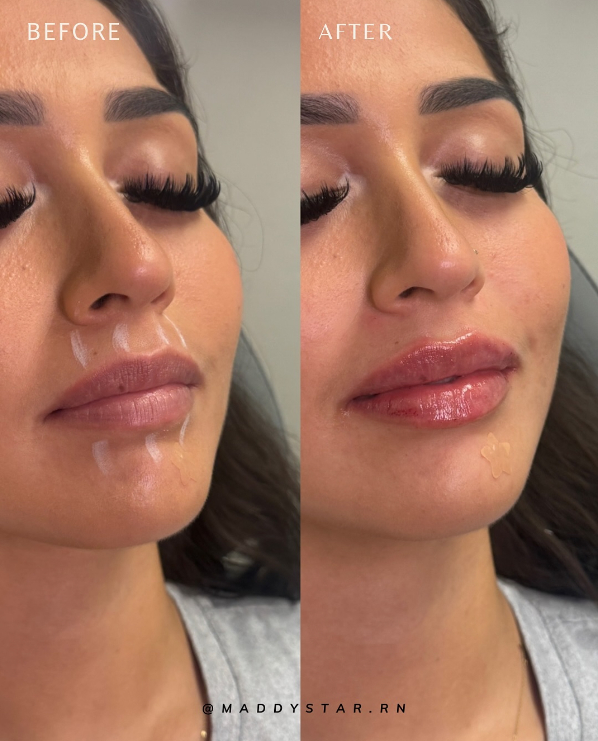 Lip filler before and after at SDBotox San Diego