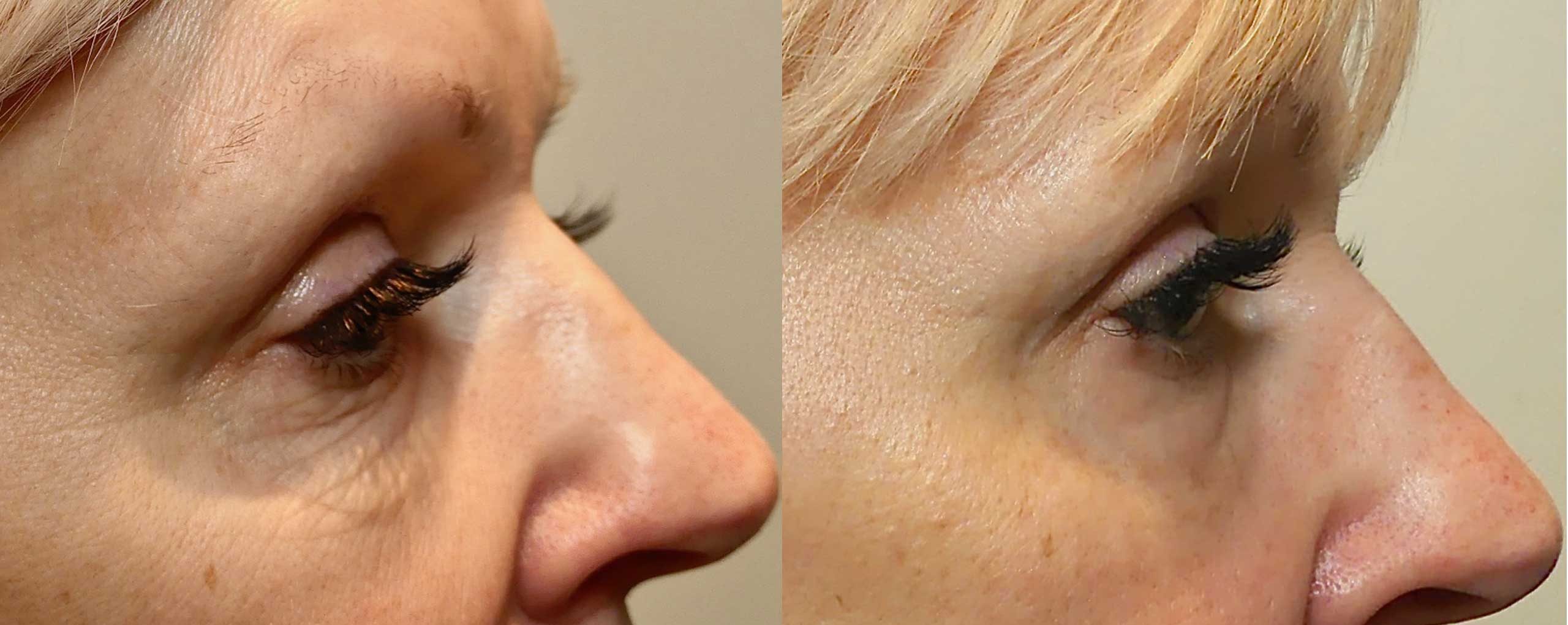 Morpheus8 under eyes before and after