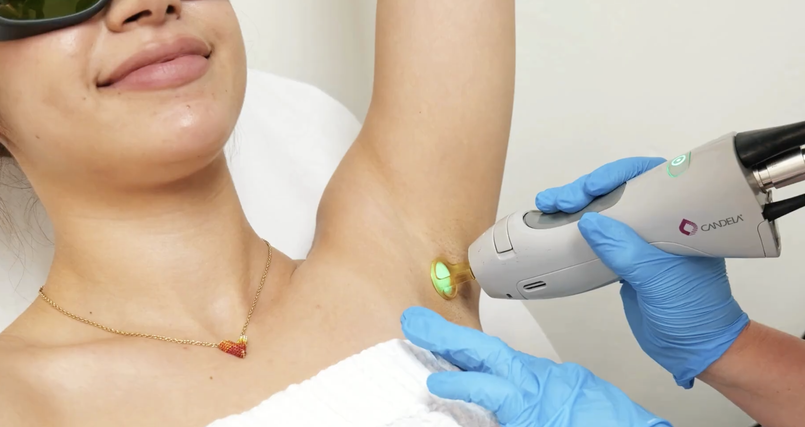 Laser hair removal at SDBotox in San Diego