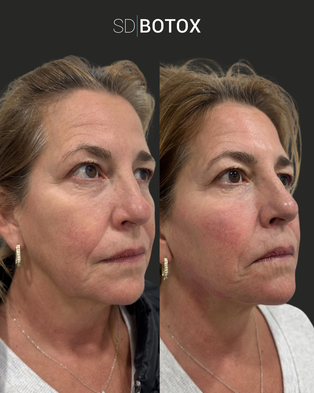 Natural dermal filler before and after at SDBotox San Diego