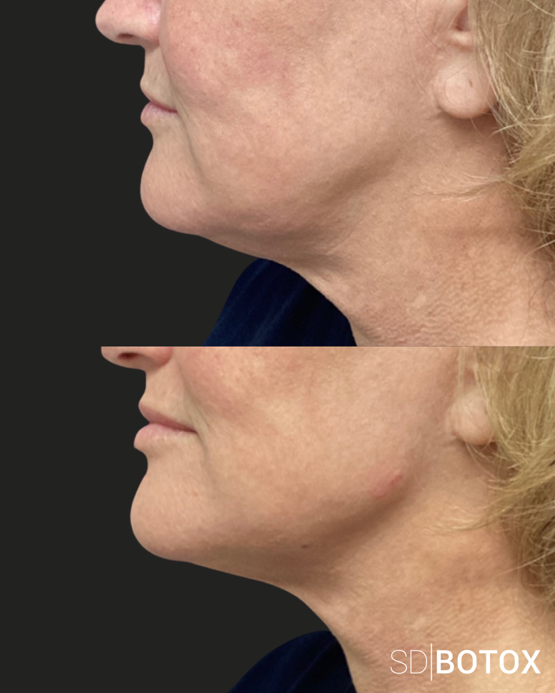 Natural dermal filler before and after at SDBotox San Diego