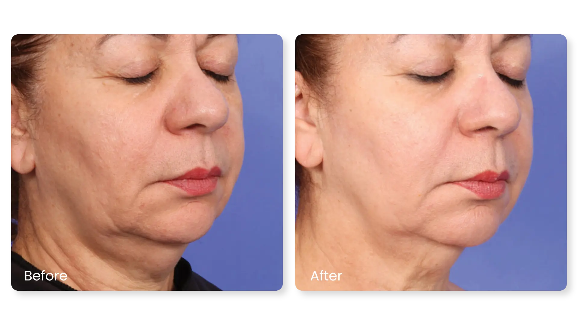 XERF structural skin tightening before and after results